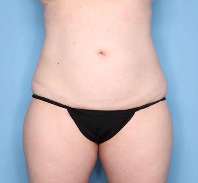 Case--39024 | After Liposuction