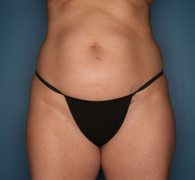 Case--39124 | Before Liposuction