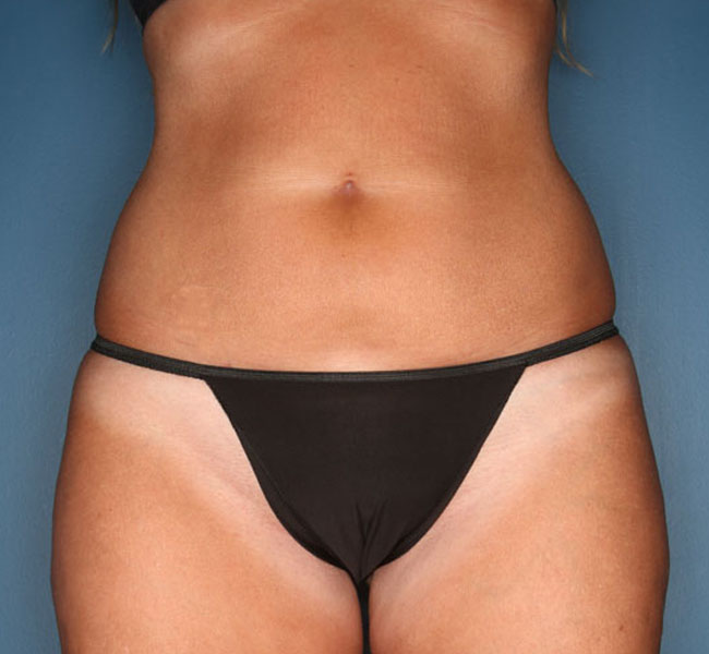 Case--39224 | Before Liposuction