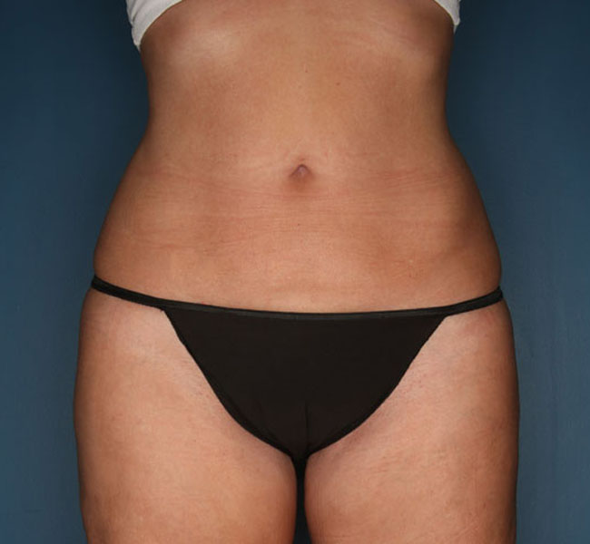 Case--39224 | After Liposuction