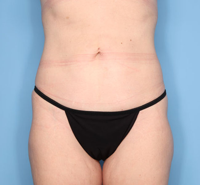 Case--39324 | After Liposuction