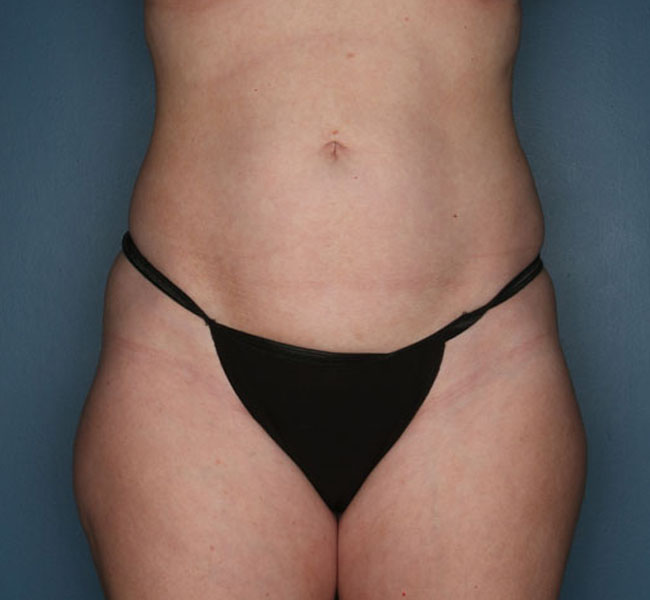 Case--39424 | Before Liposuction