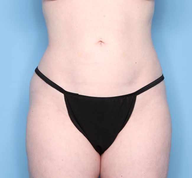 Case--39424 | After Liposuction