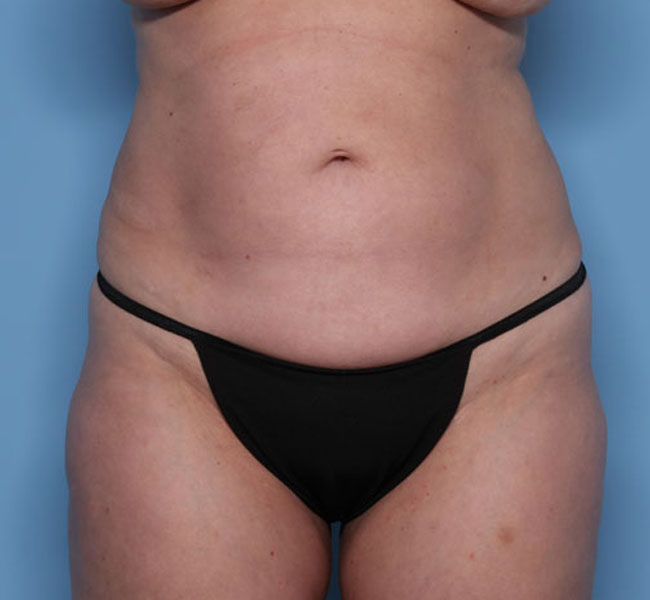 Case--39524 | Before Liposuction