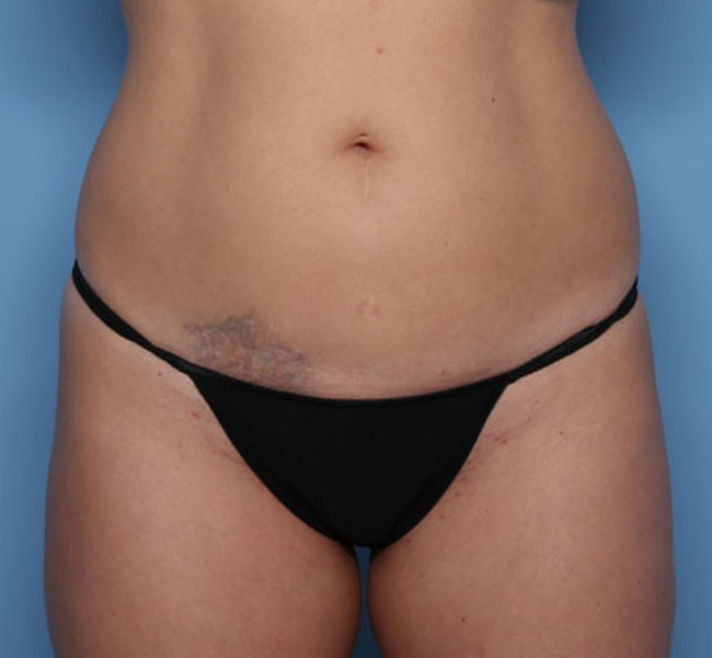 Case--39624 | Before Liposuction