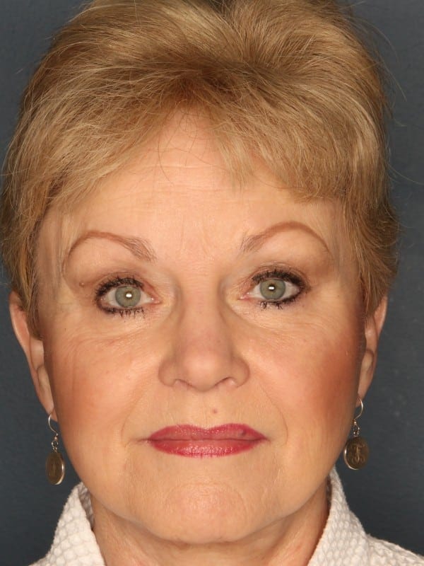 Facelift-Patient-02 | After Facelift