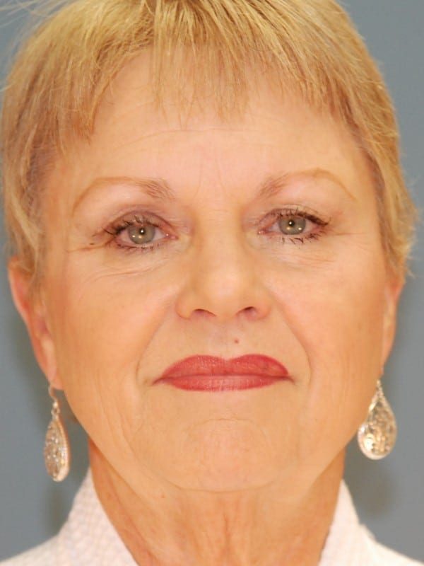 Facelift-Patient-02 | Before Facelift