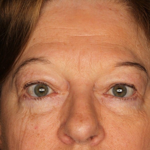 Eyelid After Patient Photo