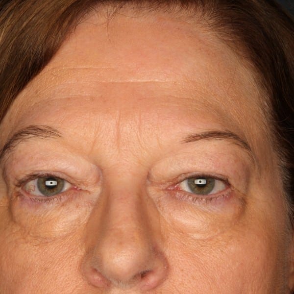 Eyelid Before Patient Photo