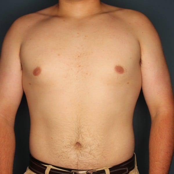 After Male Breast Reduction