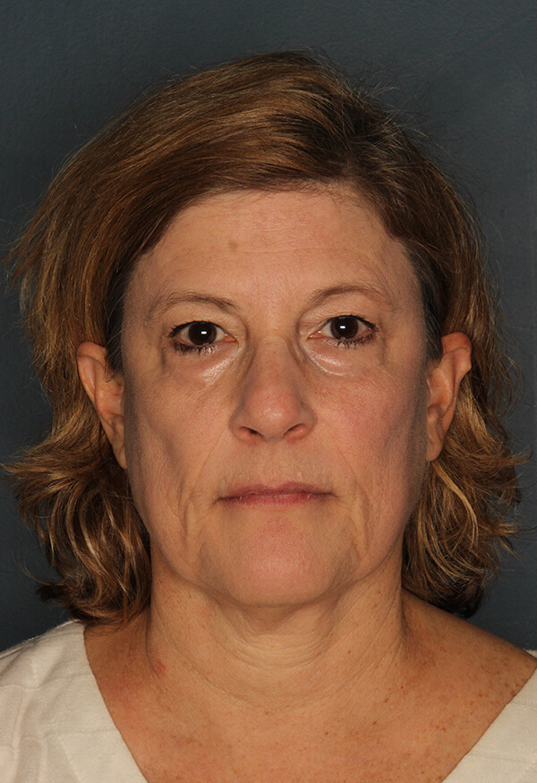 Case--0304 | Before Facelift