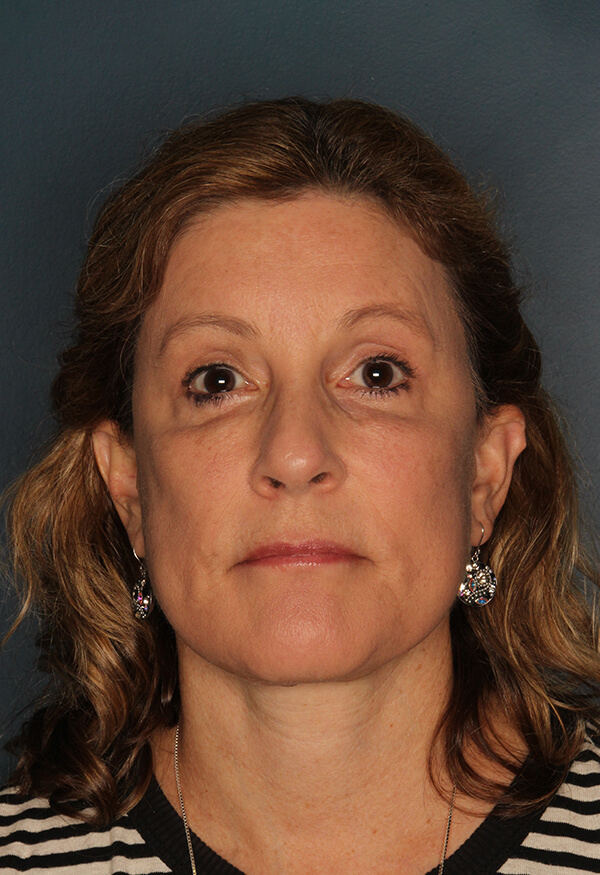 Case--0304 | After Facelift