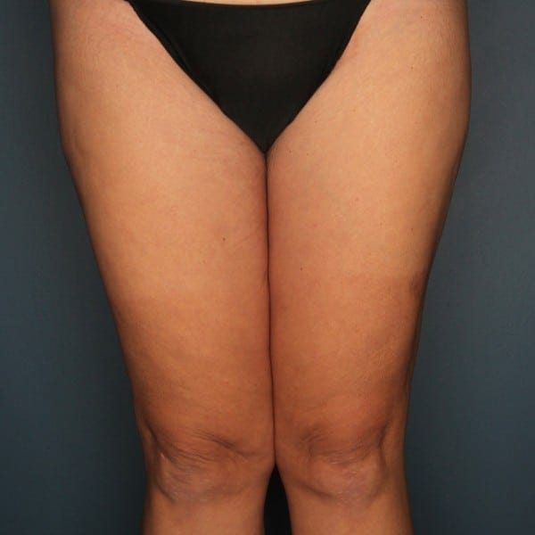 After Thigh Lift Surgery