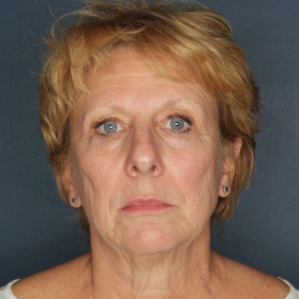 Facelift-Patient-04 | Before Facelift