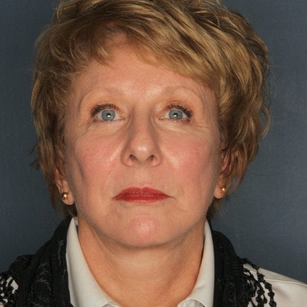 Facelift-Patient-04 | After Facelift