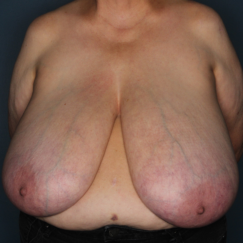 Case--10124 | Before Breast Reduction with Lift