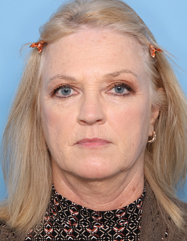 Case--2669 | Before Facelift