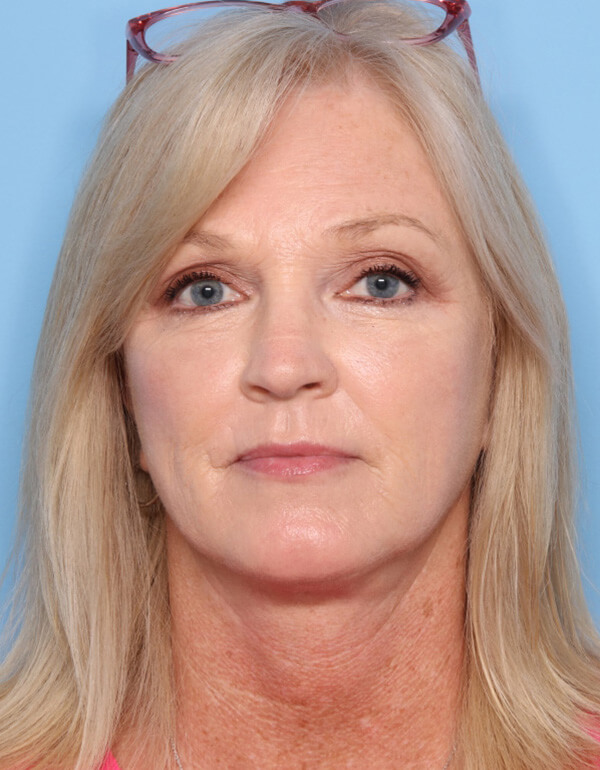 Case--2669 | After Facelift