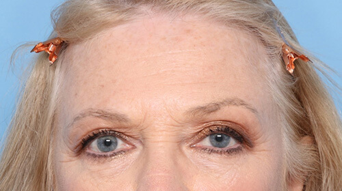 Case--7734 | Before Face