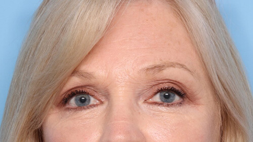 Case--7734 | After Face