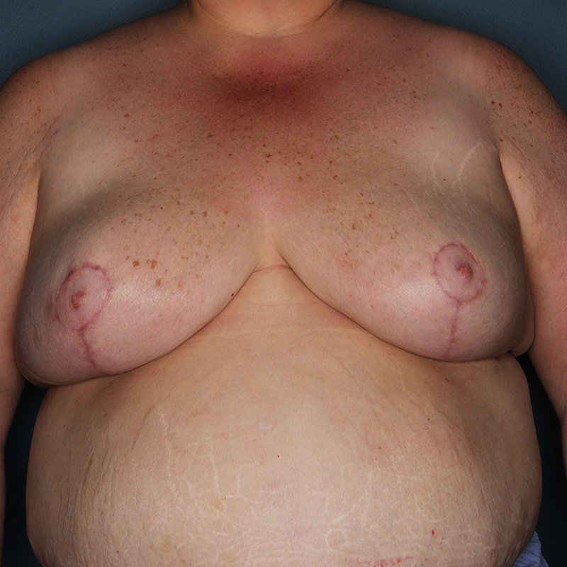 Case--10424 | After Breast Reduction with Lift