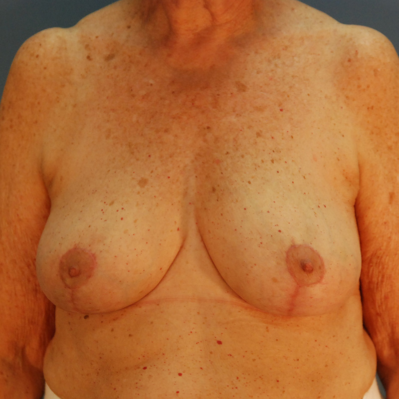 Case--10924 | After Breast Reduction with Lift