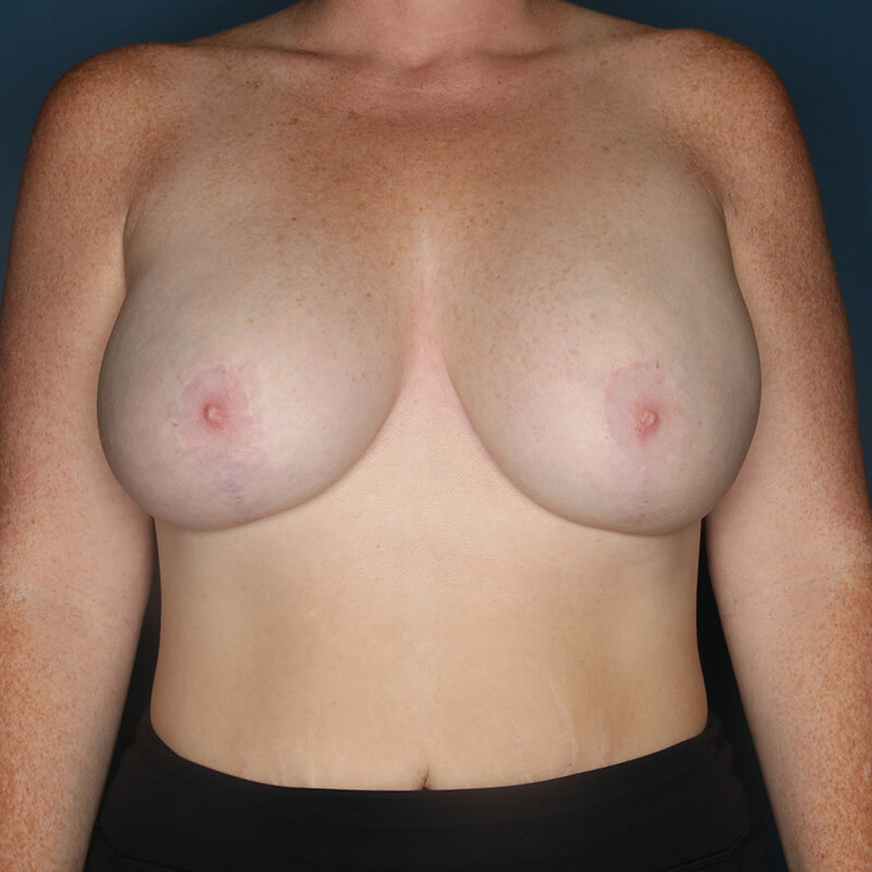 Case--13024 | After Cosmetic Breast Surgery