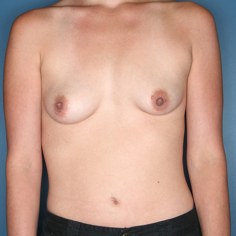 Case--14524 | Before Correction of Breast Asymmetry