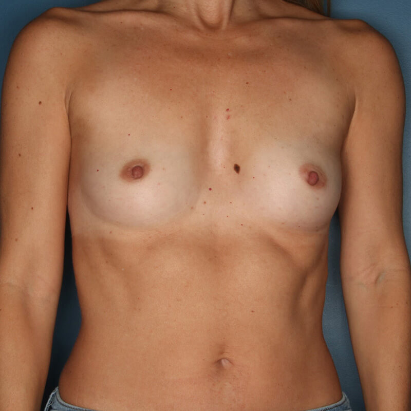 Case--1524 | Before Breast Augmentation