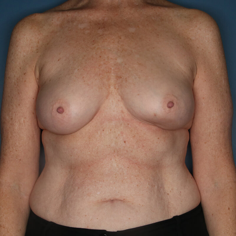 Case--16324 | Before Reconstructive Breast Surgery