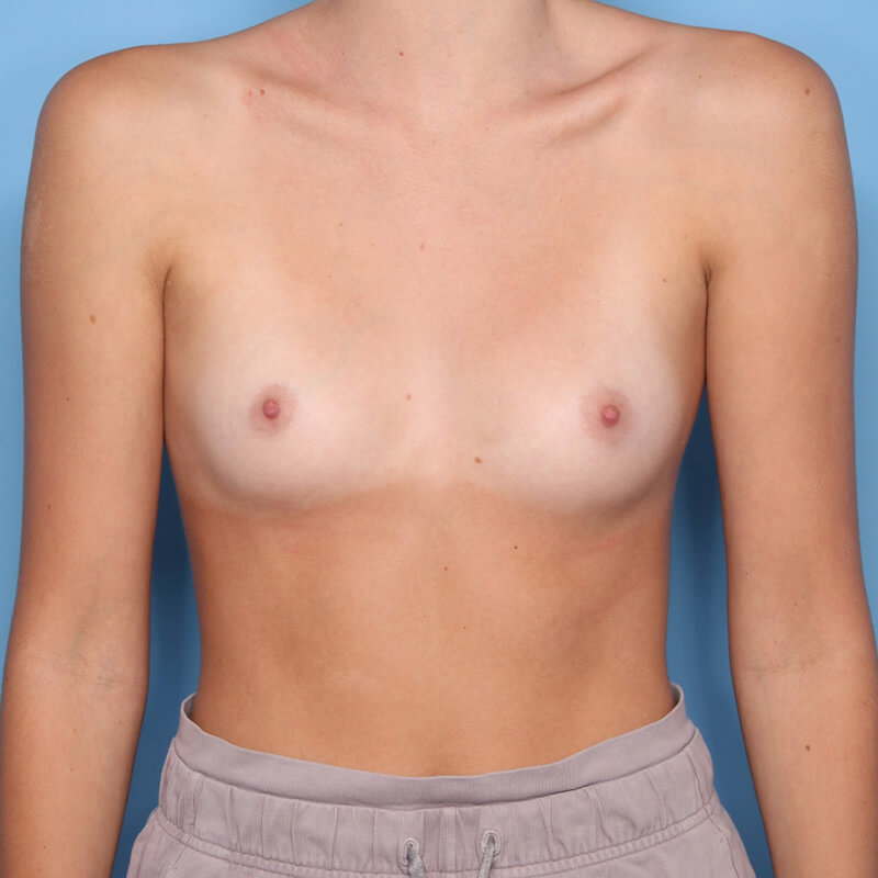 Case--1724 | Before Breast Augmentation