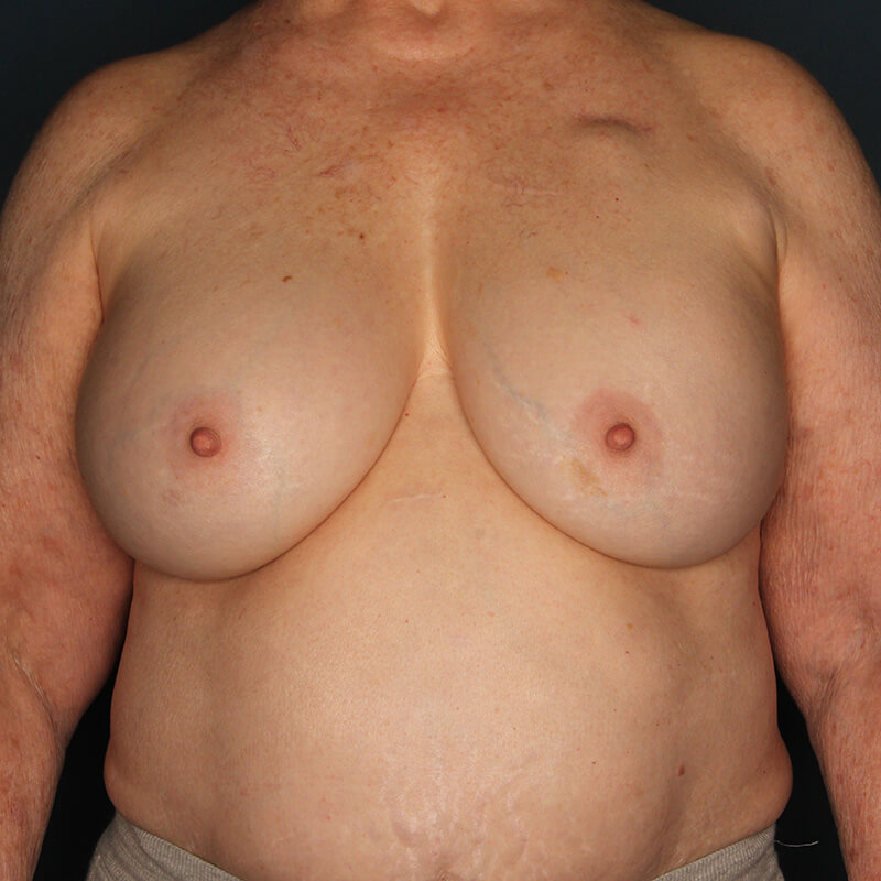 Case--17324 | Before Latissimus Flap Reconstruction