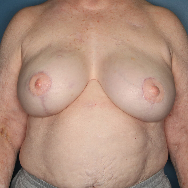 Case--17324 | After Latissimus Flap Reconstruction