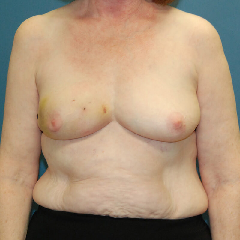 Case--17624 | Before Reconstructive Breast Surgery