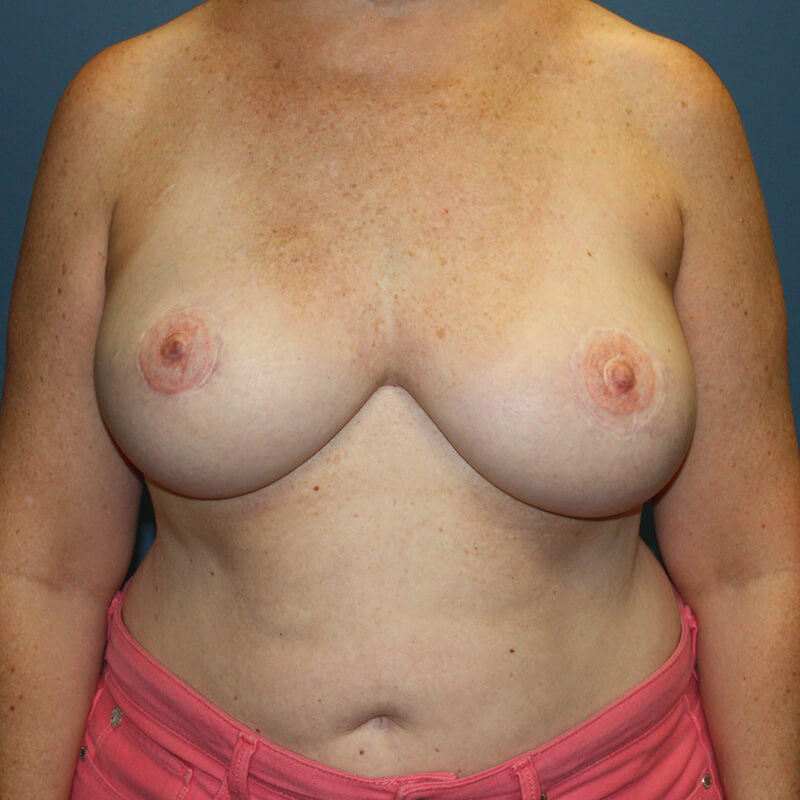 Case--17824 | After Reconstructive Breast Surgery