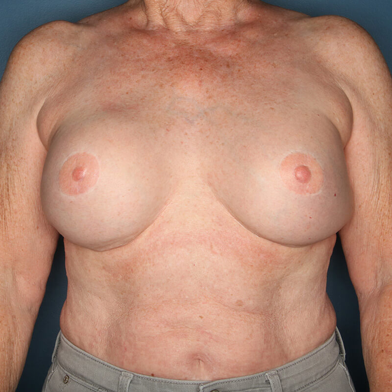 Case--18524 | After Reconstructive Breast Surgery