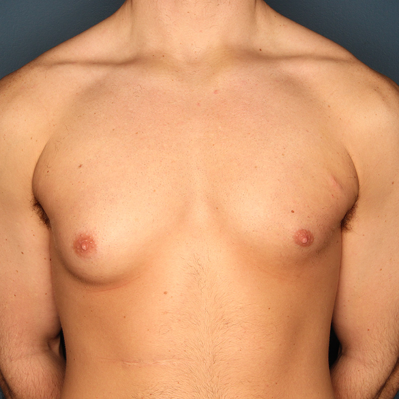 Case--18724 | Before Cosmetic Breast Surgery