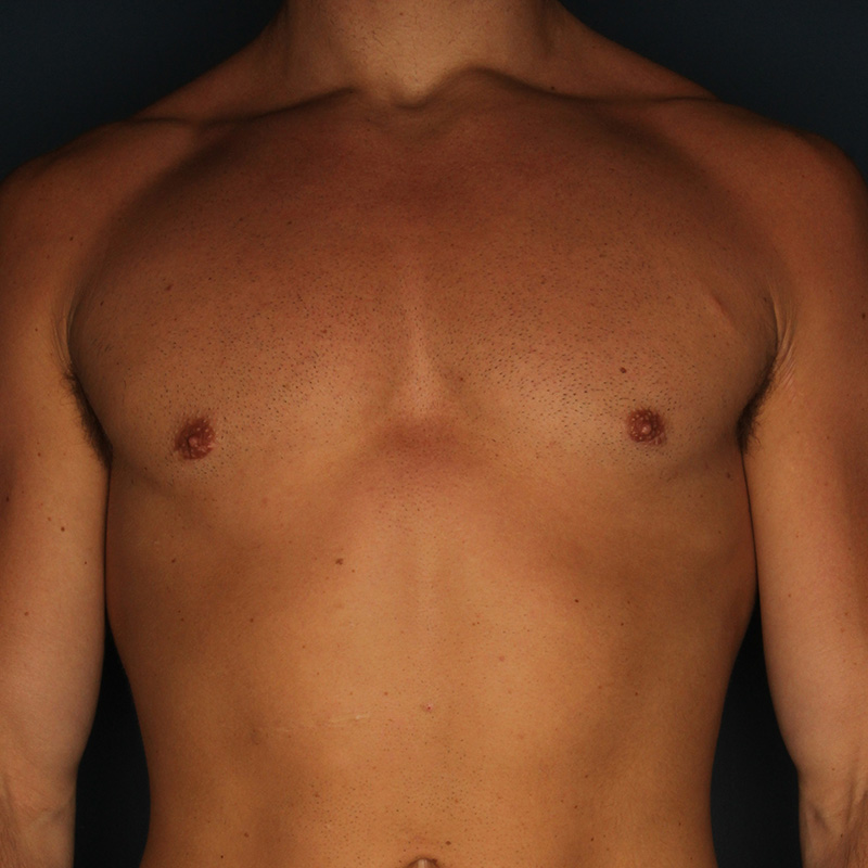 Case--18724 | After Cosmetic Breast Surgery