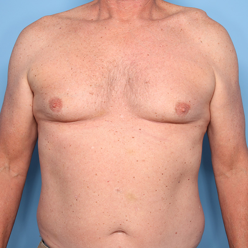 Case--18824 | Before Cosmetic Breast Surgery