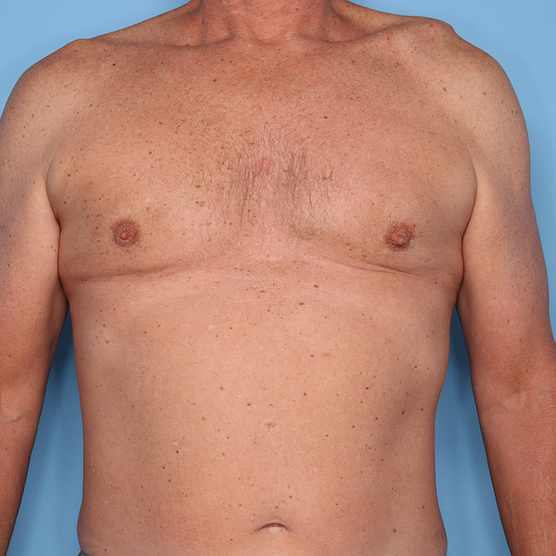 Case--18824 | After Cosmetic Breast Surgery