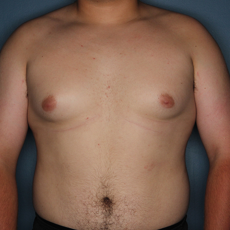 Case--18924 | Before Cosmetic Breast Surgery