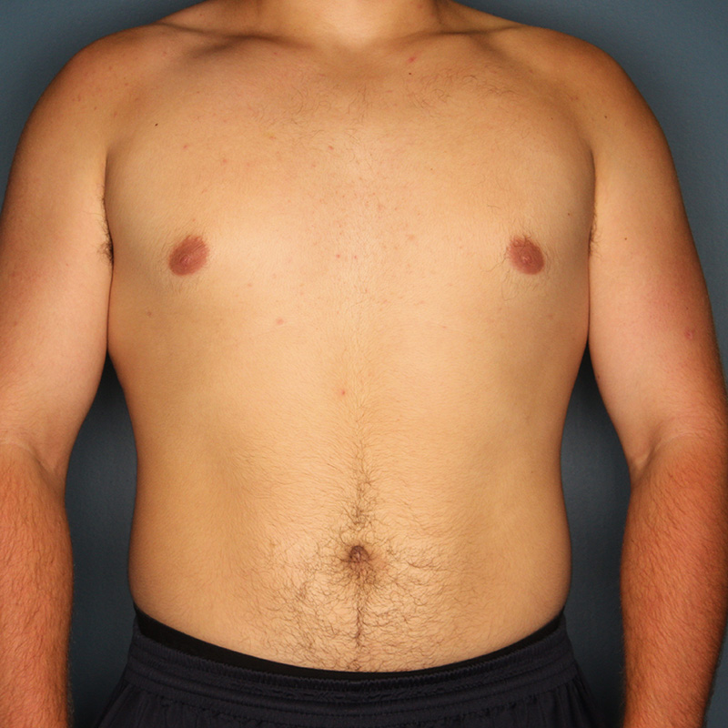 Case--18924 | After Cosmetic Breast Surgery