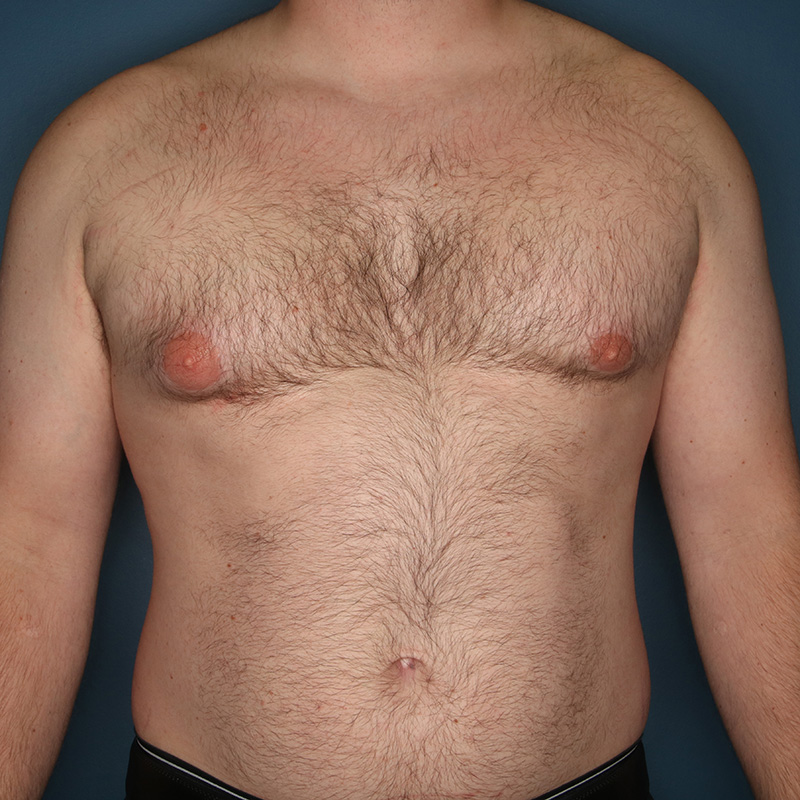 Case--19024 | Before Cosmetic Breast Surgery