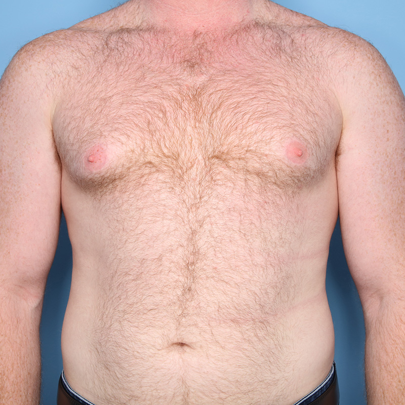 Case--19124 | Before Cosmetic Breast Surgery