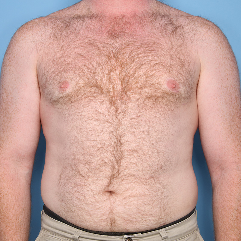 Case--19124 | After Cosmetic Breast Surgery