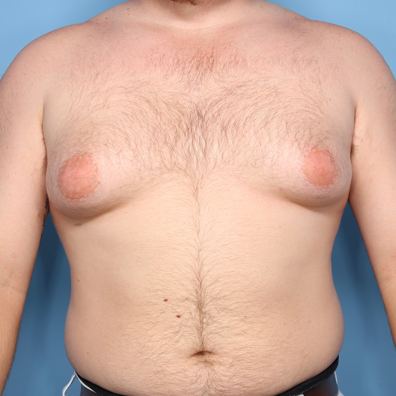 Case--19224 | Before Cosmetic Breast Surgery