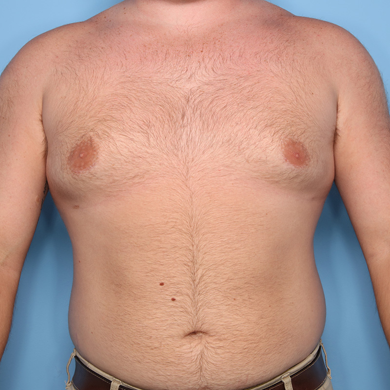Case--19224 | After Cosmetic Breast Surgery