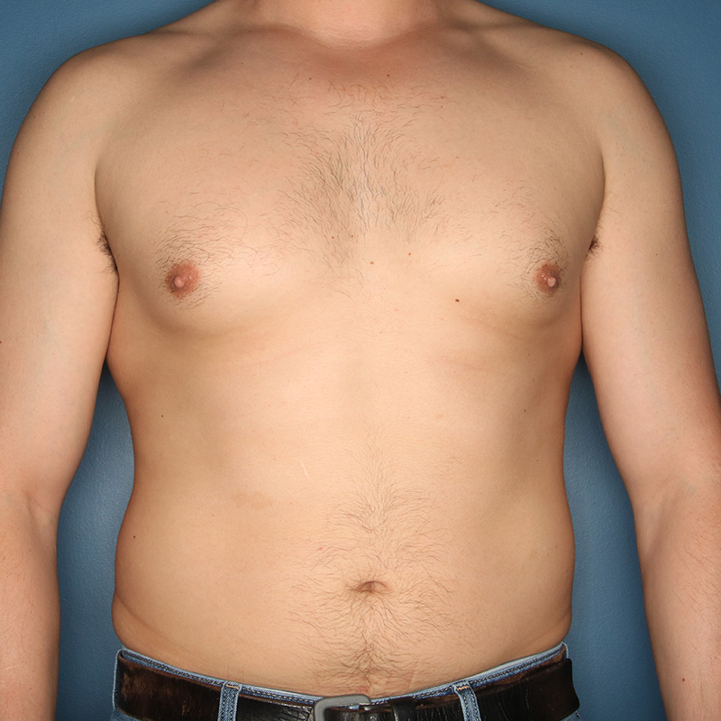 Case--19324 | Before Cosmetic Breast Surgery