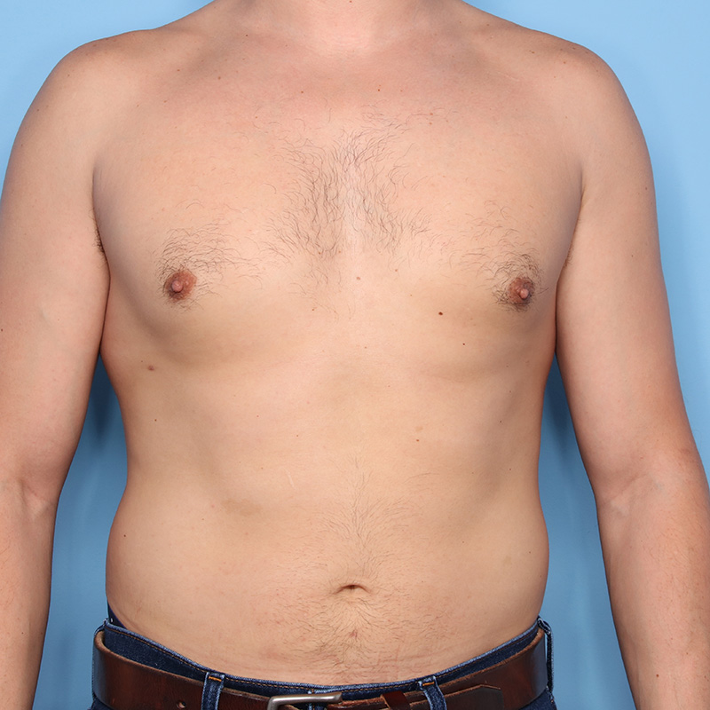 Case--19324 | After Cosmetic Breast Surgery