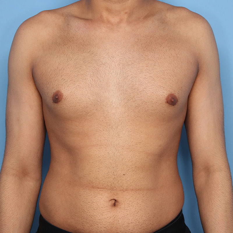 Case--19424 | After Cosmetic Breast Surgery